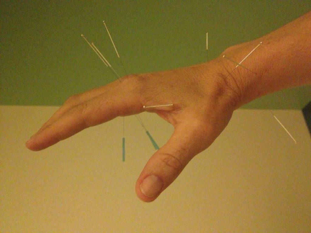 Hand with Acupuncture needles