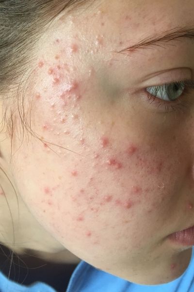 Teen Acne treatment at home